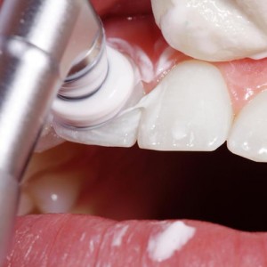 limpieza dental gessal